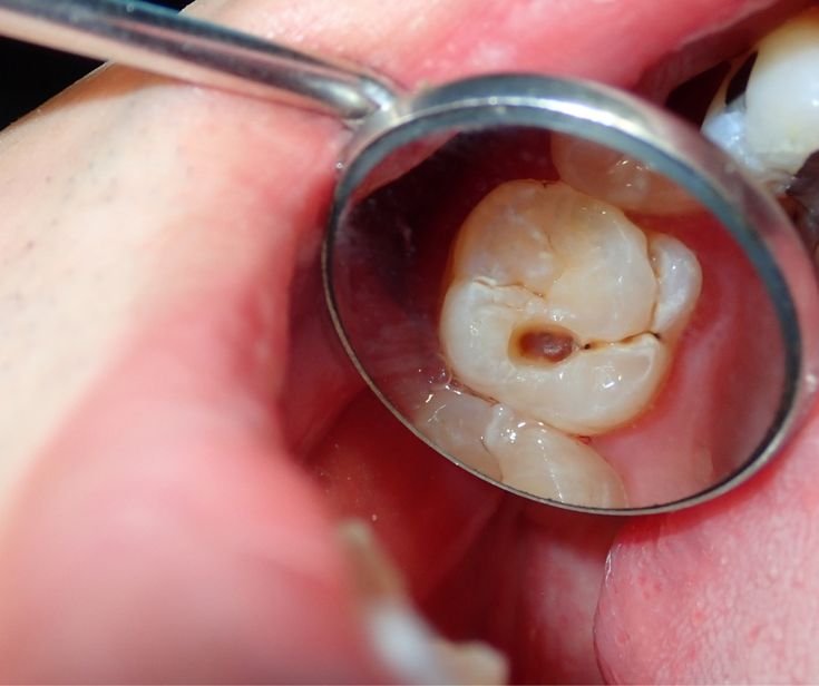 Dampak Buruk Jika Tidak Merawat Gigi